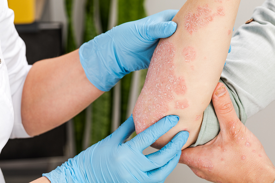 Dermatologist examines a patient's Eczema